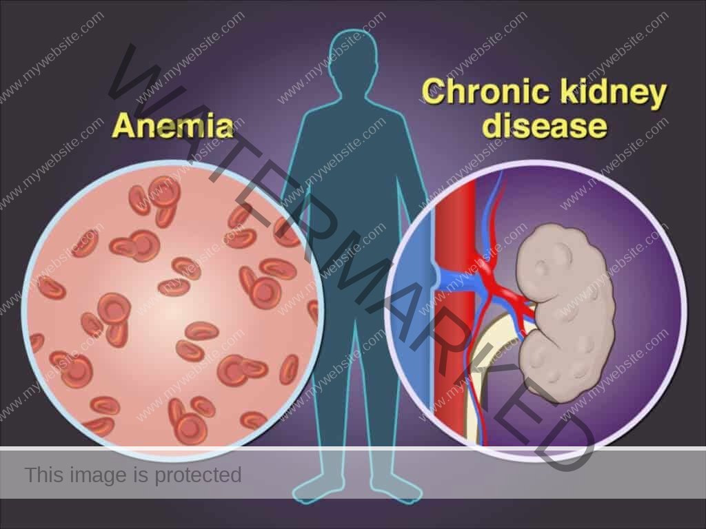 CKD anemia